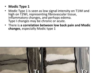 Degenerative diseases of spine : Imaging | PPTX