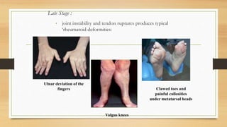 Late Stage :
• joint instability and tendon ruptures produces typical
‘rheumatoid deformities:
Ulnar deviation of the
fingers
Valgus knees
Clawed toes and
painful callosities
under metatarsal heads
 