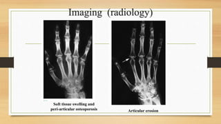 Imaging (radiology)
Soft tissue swelling and
peri-articular osteoporosis Articular erosion
 