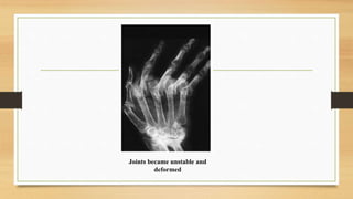 Joints became unstable and
deformed
 