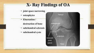 • joint space narrowing
• osteophytes
• Eburnation /
destruction of bone
• subchondral sclerosis
• subchondral cysts
(http://www.orthobullets.com/recon/5005/osteoarthritis)
 