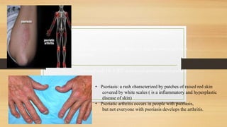 A seronegative spondyloarthropathy ( RF negative)
A chronic inflammatory disease of skin( psoriasis) and joint
(arthritis).
Classified with HLA-B27 associated spondyloarthropathies
• Psoriasis: a rash characterized by patches of raised red skin
covered by white scales ( is a inflammatory and hyperplastic
disease of skin)
• Psoriatic arthritis occurs in people with psoriasis,
but not everyone with psoriasis develops the arthritis.
 