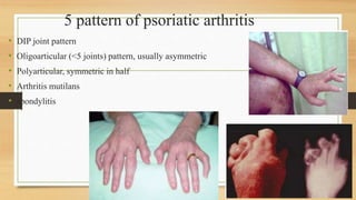 5 pattern of psoriatic arthritis
• DIP joint pattern
• Oligoarticular (<5 joints) pattern, usually asymmetric
• Polyarticular, symmetric in half
• Arthritis mutilans
• spondylitis
 