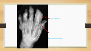 Calcified tophus
Overhanging margins
 