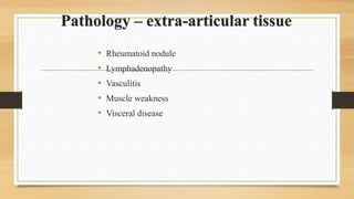 Pathology – extra-articular tissue
• Rheumatoid nodule
• Lymphadenopathy
• Vasculitis
• Muscle weakness
• Visceral disease
 