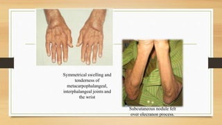 Symmetrical swelling and
tenderness of
metacarpophalangeal,
interphalangeal joints and
the wrist
Subcutaneous nodule felt
over olecranon process.
 