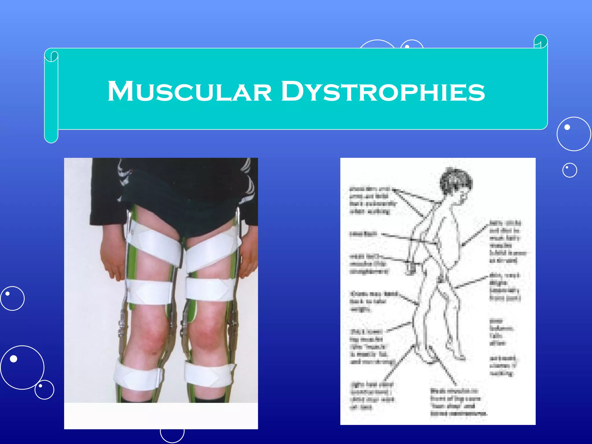 Muscular Dystrophies 