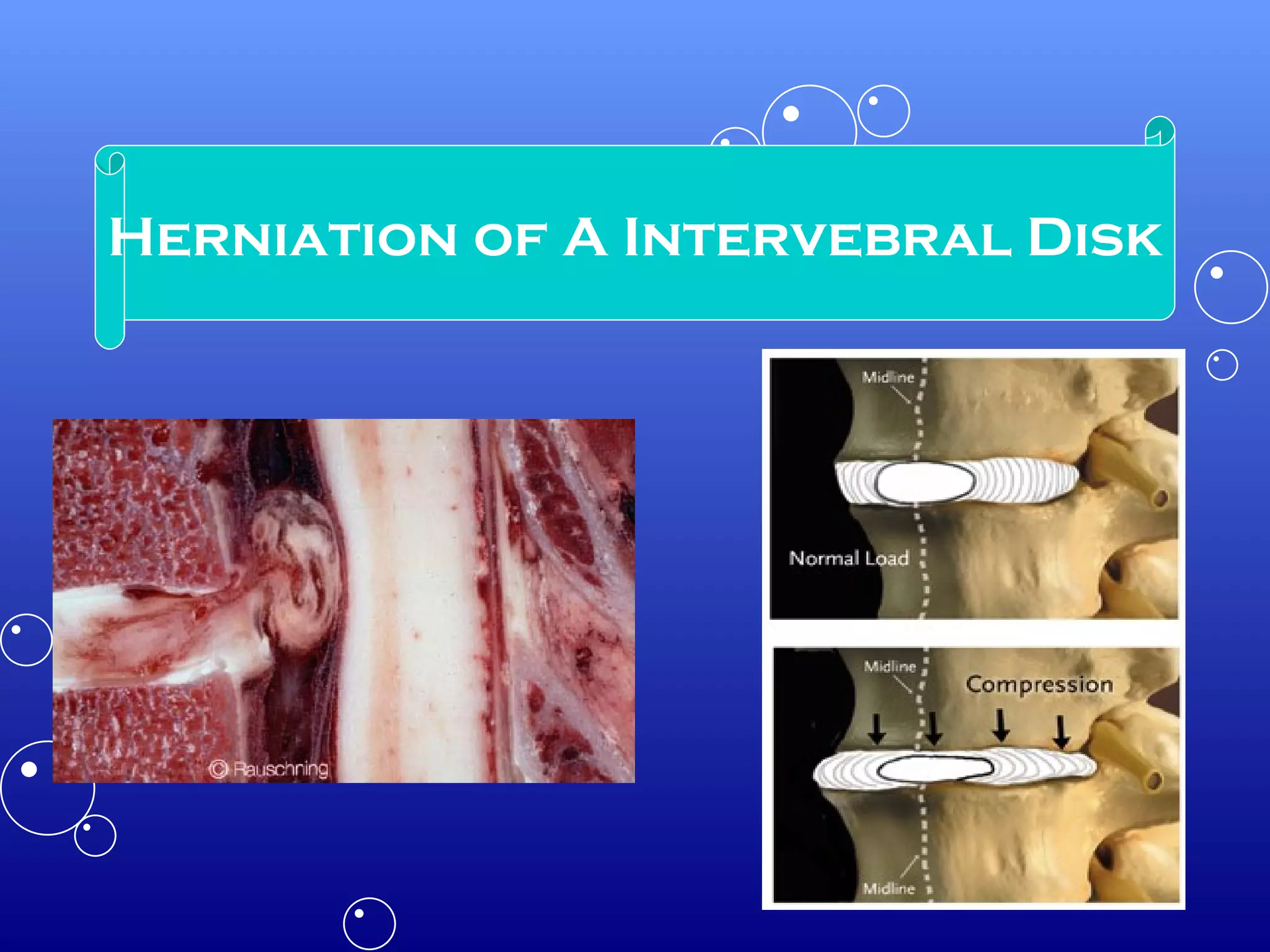 Herniation of A Intervebral Disk 