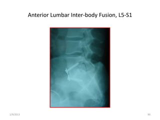 Anterior Lumbar Inter-body Fusion, L5-S1
1/9/2013 90
 