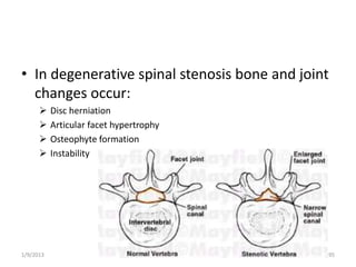 • In degenerative spinal stenosis bone and joint
changes occur:
 Disc herniation
 Articular facet hypertrophy
 Osteophyte formation
 Instability
1/9/2013 95
 