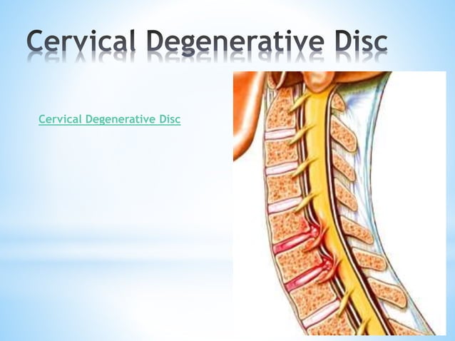 Degenerative spine