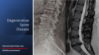 Degenerative
Spine
Disease
Visit and read it freely here -
https://sethiortho.blogspot.com
SethiNet presentations
 