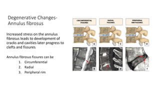 Degenerative Changes-
Annulus fibrosus
Increased stress on the annulus
fibrosus leads to development of
cracks and cavities later progress to
clefts and fissures.
Annulus fibrosus fissures can be
1. Circumferential
2. Radial
3. Peripheral rim
 