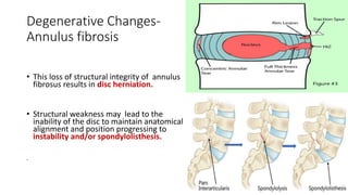 Degenerative Changes-
Annulus fibrosis
• This loss of structural integrity of annulus
fibrosus results in disc herniation.
• Structural weakness may lead to the
inability of the disc to maintain anatomical
alignment and position progressing to
instability and/or spondylolisthesis.
.
 
