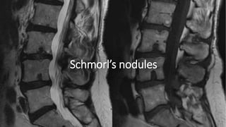 Schmorl’s nodules
 