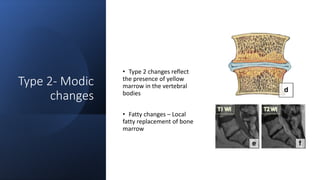 Type 2- Modic
changes
• Type 2 changes reflect
the presence of yellow
marrow in the vertebral
bodies
• Fatty changes – Local
fatty replacement of bone
marrow
 
