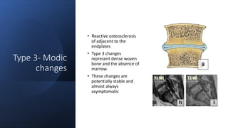 Type 3- Modic
changes
• Reactive osteosclerosis
of adjacent to the
endplates
• Type 3 changes
represent dense woven
bone and the absence of
marrow.
• These changes are
potentially stable and
almost always
asymptomatic
 