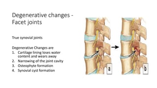 Degenerative changes -
Facet joints
True synovial joints
Degenerative Changes are
1. Cartilage lining loses water
content and wears away
2. Narrowing of the joint cavity
3. Osteophyte formation
4. Synovial cyst formation
 
