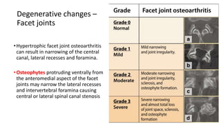 Degenerative changes –
Facet joints
•Hypertrophic facet joint osteoarthritis
can result in narrowing of the central
canal, lateral recesses and foramina.
•Osteophytes protruding ventrally from
the anteromedial aspect of the facet
joints may narrow the lateral recesses
and intervertebral foramina causing
central or lateral spinal canal stenosis
 