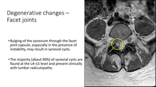 Degenerative changes –
Facet joints
•Bulging of the synovium through the facet
joint capsule, especially in the presence of
instability, may result in synovial cysts.
•The majority (about 90%) of synovial cysts are
found at the L4–L5 level and present clinically
with lumbar radiculopathy.
 