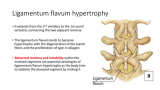 Ligamentum flavum hypertrophy
• It extends from the 2nd vertebra to the 1st sacral
vertebra, connecting the two adjacent laminae
• The ligamentum flavum tends to become
hypertrophic with the degeneration of the elastic
fibres and the proliferation of type II collagen.
• Abnormal motions and instability within the
involved segments are potential aetiologies of
ligamentum flavum hypertrophy as the body tries
to stabilise the diseased segment by making it
 