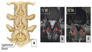 • Surgical removal is the only
therapeutic manoeuvre for
patients with symptoms caused
by ligamentum flavum
hypertrophy (Fig. 26b, c).
 
