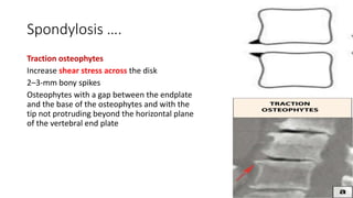 Spondylosis ….
Traction osteophytes
Increase shear stress across the disk
2–3-mm bony spikes
Osteophytes with a gap between the endplate
and the base of the osteophytes and with the
tip not protruding beyond the horizontal plane
of the vertebral end plate
 