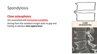 Spondylosis
Claw osteophytes
Are associated with horizontal instability.
Arising from the vertebral margin with no gap and
having an obvious claw appearance
 