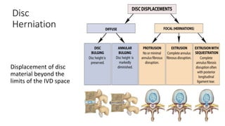 Disc
Herniation
Displacement of disc
material beyond the
limits of the IVD space
 