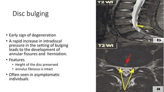 Disc bulging
• Early sign of degeneration
• A rapid increase in intradiscal
pressure in the setting of bulging
leads to the development of
annular fissures and herniation.
• Features
• Height of the disc preserved
• annulus fibrosus is intact
• Often seen in asymptomatic
individuals
 