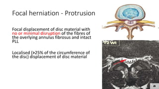 Focal herniation - Protrusion
Focal displacement of disc material with
no or minimal disruption of the fibres of
the overlying annulus fibrosus and intact
PLL
Localised (>25% of the circumference of
the disc) displacement of disc material
 