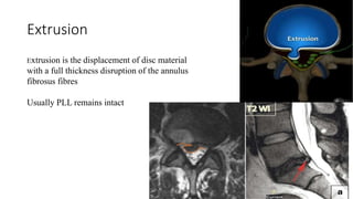 Extrusion
Extrusion is the displacement of disc material
with a full thickness disruption of the annulus
fibrosus fibres
Usually PLL remains intact
 