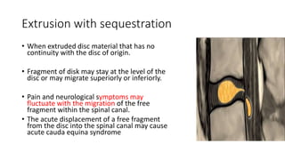 Extrusion with sequestration
• When extruded disc material that has no
continuity with the disc of origin.
• Fragment of disk may stay at the level of the
disc or may migrate superiorly or inferiorly.
• Pain and neurological symptoms may
fluctuate with the migration of the free
fragment within the spinal canal.
• The acute displacement of a free fragment
from the disc into the spinal canal may cause
acute cauda equina syndrome
 