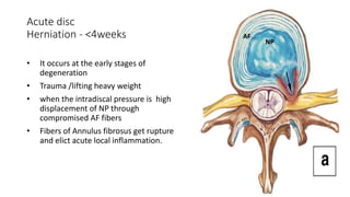 Acute disc
Herniation - <4weeks
• It occurs at the early stages of
degeneration
• Trauma /lifting heavy weight
• when the intradiscal pressure is high
displacement of NP through
compromised AF fibers
• Fibers of Annulus fibrosus get rupture
and elict acute local inflammation.
NP
AF
 