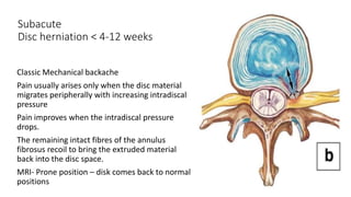 Subacute
Disc herniation < 4-12 weeks
Classic Mechanical backache
Pain usually arises only when the disc material
migrates peripherally with increasing intradiscal
pressure
Pain improves when the intradiscal pressure
drops.
The remaining intact fibres of the annulus
fibrosus recoil to bring the extruded material
back into the disc space.
MRI- Prone position – disk comes back to normal
positions
 