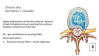 Chronic disc
herniation < 12weeks
Stable displacement of the disc material - because
of high intradiscal pressure pushing the nucleous
pulposus material out of the disc
AF – get calcified loss of recoiling effect
Excess axial stress –
1. Tearing of annular fibers – Acute stage pain
 