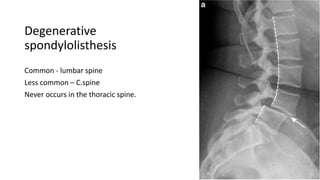 Degenerative
spondylolisthesis
Common - lumbar spine
Less common – C.spine
Never occurs in the thoracic spine.
 