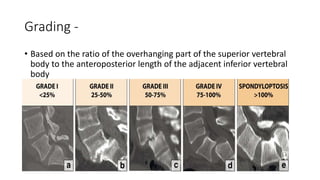 Grading -
• Based on the ratio of the overhanging part of the superior vertebral
body to the anteroposterior length of the adjacent inferior vertebral
body
 