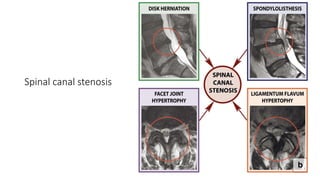 Spinal canal stenosis
 