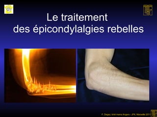 Le traitement  des épicondylalgies rebelles F. Degez, kiné mains Angers - JFK, Marseille 2011 