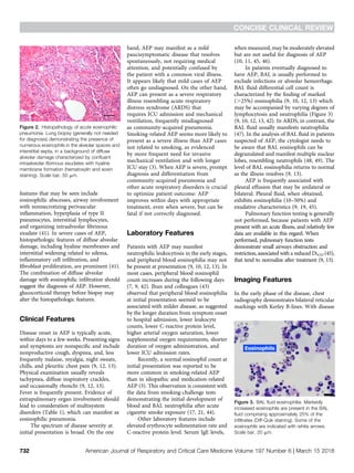 Comprehensive Clinical Review of Acute Eosinophilic Pneumonia: Causes ...