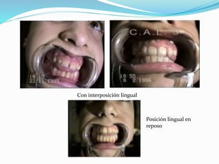 Con interposición lingual
Posición lingual en
reposo
 