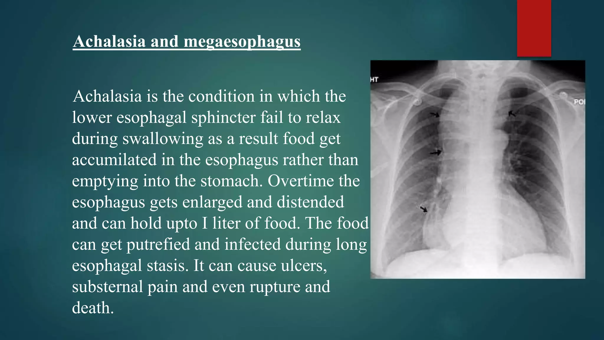 Achalasia and megaesophagus
Achalasia is the condition in which the
lower esophagal sphincter fail to relax
during swallowing as a result food get
accumilated in the esophagus rather than
emptying into the stomach. Overtime the
esophagus gets enlarged and distended
and can hold upto I liter of food. The food
can get putrefied and infected during long
esophagal stasis. It can cause ulcers,
substernal pain and even rupture and
death.
 