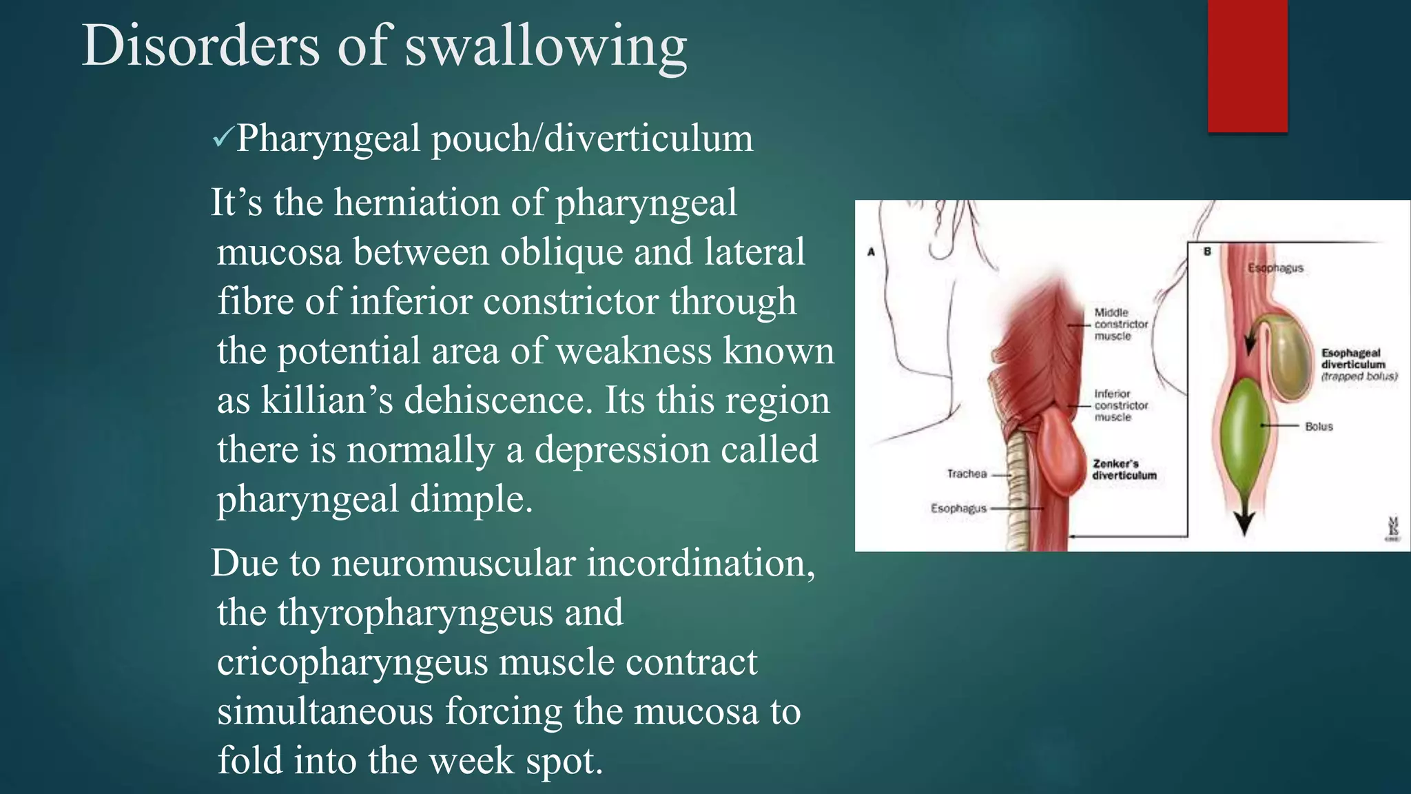 Disorders of swallowing
Pharyngeal pouch/diverticulum
It’s the herniation of pharyngeal
mucosa between oblique and lateral
fibre of inferior constrictor through
the potential area of weakness known
as killian’s dehiscence. Its this region
there is normally a depression called
pharyngeal dimple.
Due to neuromuscular incordination,
the thyropharyngeus and
cricopharyngeus muscle contract
simultaneous forcing the mucosa to
fold into the week spot.
 