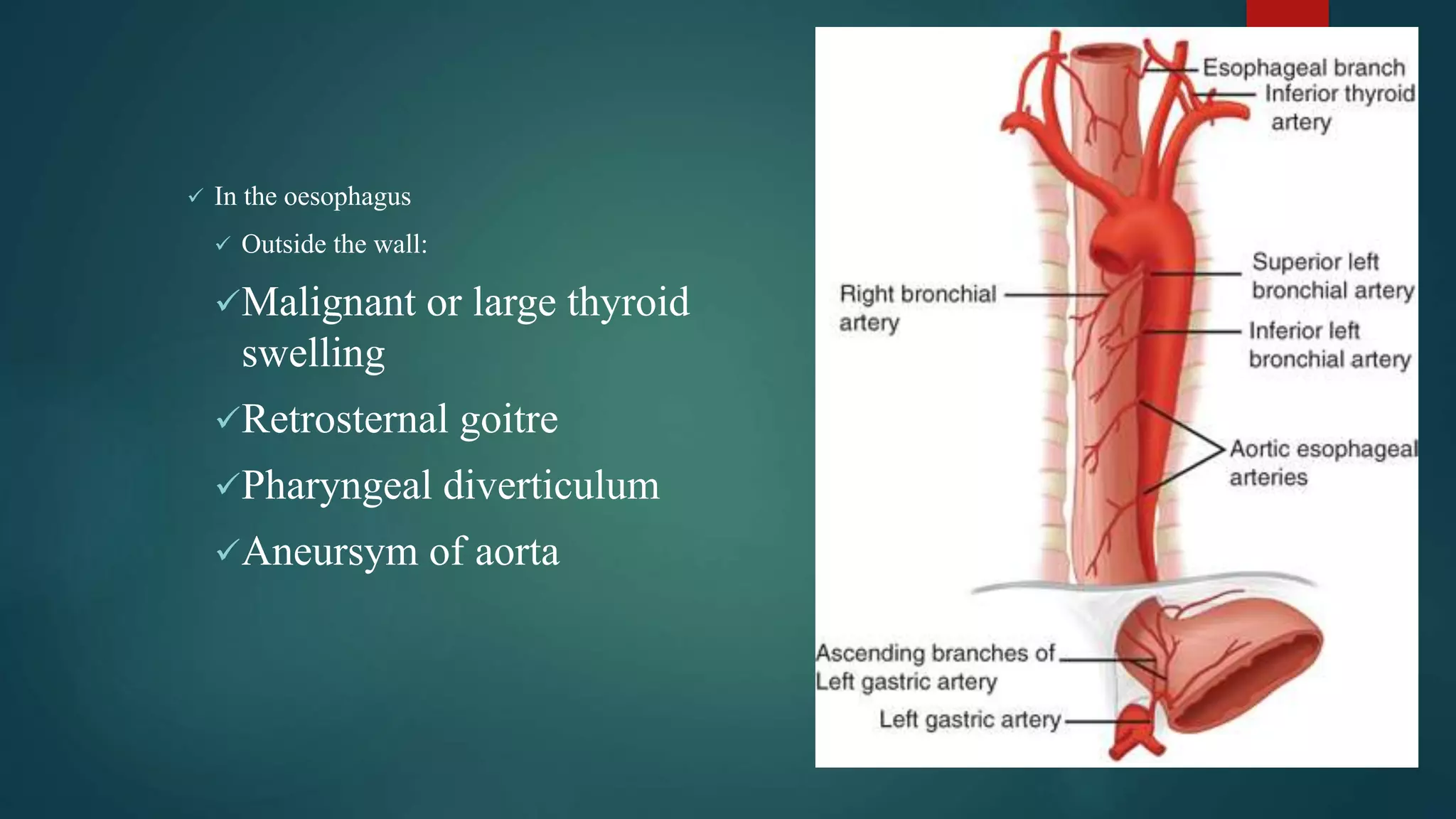  In the oesophagus
 Outside the wall:
Malignant or large thyroid
swelling
Retrosternal goitre
Pharyngeal diverticulum
Aneursym of aorta
 