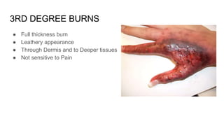 3RD DEGREE BURNS
● Full thickness burn
● Leathery appearance
● Through Dermis and to Deeper tissues
● Not sensitive to Pain
 