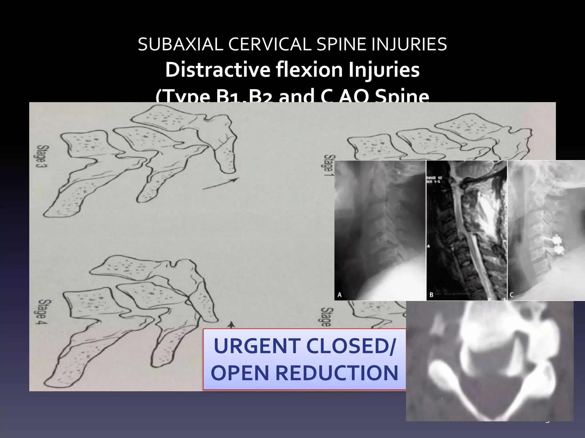 Subaxial Cervical Spine Injuries | PPTX