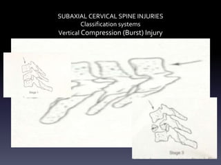 SUBAXIAL CERVICAL SPINE INJURIES
Classification systems
Vertical Compression (Burst) Injury
(Type A3 AO Spine/ SLIC- Compression/ Burst)
18
 