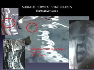 SUBAXIAL CERVICAL SPINE INJURIES
Illustrative Cases
Distractive Flexion Injury Stage 3
Type C#
SLIC- 3+2+2=7
27
 