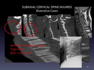 SUBAXIAL CERVICAL SPINE INJURIES
Illustrative Cases
Vertical Compression Injury
Type A3 #
SLIC- 2+0+3+1=6
28
 